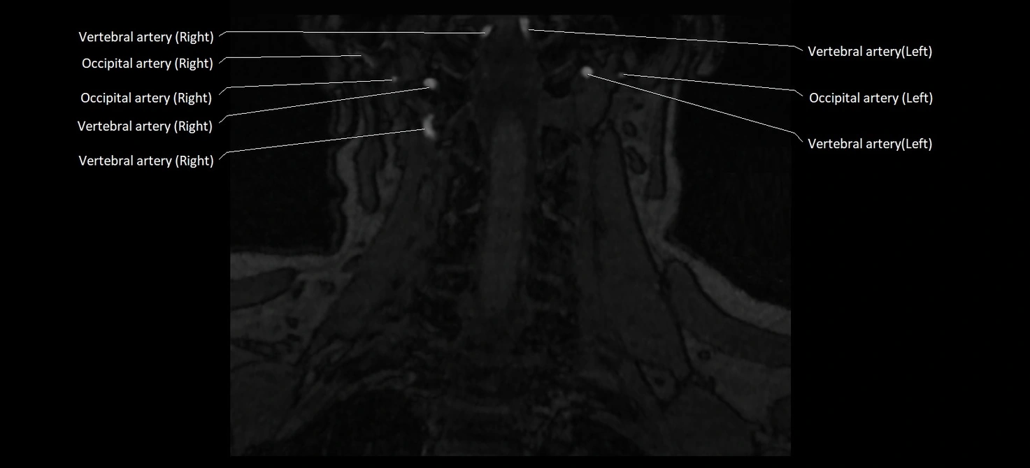 MRA carotid artery anatomy cross sectional 3T coronal image 14.webp